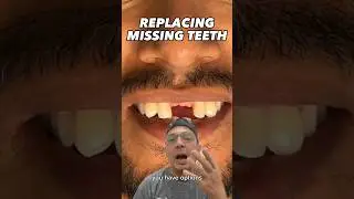 Options to Replace Missing Front Teeth | View Mobile Dental #shorts