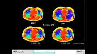 J. M. Constantin - Personalized mechanical ventilation in ARDS
