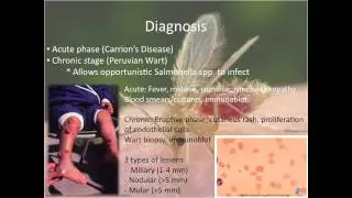 Carrion's Disease