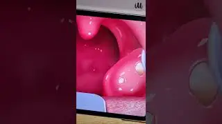 ASMR Tonsil Stone Removal Satisfying iPad Games