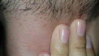 Massage therapy Asmr Satisfying | Ingrown hair Treatment | Beard hair scratching #asmr