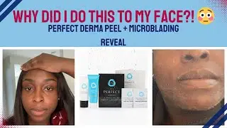 I Burned My Face on Purpose?! Derma Peel + Microblading Transformation