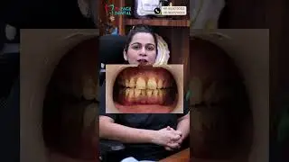 Reface Dental Meerut #dentalcare #teethwhitening #reelsvideo #meerut