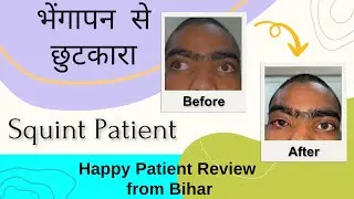 Squint Surgery | आँख के भेंगापन का इलाज | Strabismus | Happy Patient Review From Bihar