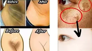 Skin lightening by 10 degrees!  Removes dye spots, sensitive area pigmentation and freckles