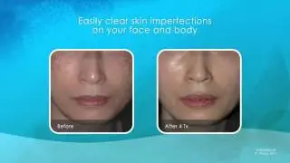Laser Facial Rejuvenation Dr Deborah Marciano , Great Neck Medical Spa