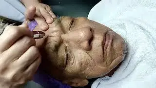 Diamond peel with glycolic acid peeling of a 70 year old male client 