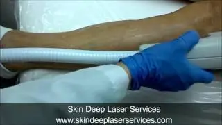 High Speed,Painless, Diode Laser Hair Removal, Fairfax County, Burke VA