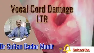 Vocal Cord Damage | Prolonged Intubation | LTB | Voice Difficulties | Dr Sultan Badar Munir