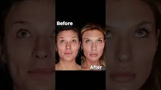 See the power of under eye filler! #undereye #bags #dark #filler #medspa #aesthetics #eyes #filler