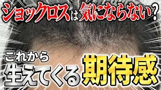 1400株の植毛手術4ヶ月後に激白「私はショックロスが...」｜生着や密度の経過をチェック