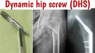 #Dynamic #hipscrew/# dynamiccondylar #screw/#orthopaedic implants#mbbs#exam