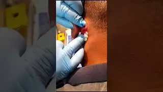 post auricular abscess drainage