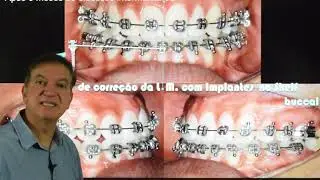 Correção da Linha Média - Prof. Dr. Pedro Andrade Jr