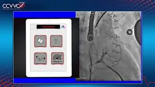 TMVR 29mm SAPIEN-3 Valve - 2018 CCC Live Case 12