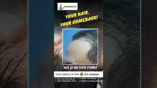 HAIR TRANSPLANT MALAYSIA | KLINIK TANAM RAMBUT #hairtransplant #hairlosstreatment #tanamrambut