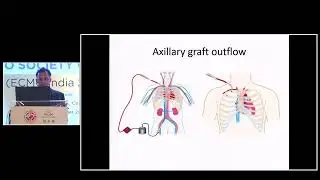 Cannulation strategies for ECMO &ndash; VA &nbsp;Dr Milind Hote