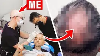 I Did an FUE Crown Hair Transplant (1,525 Grafts; Caucasian Man)