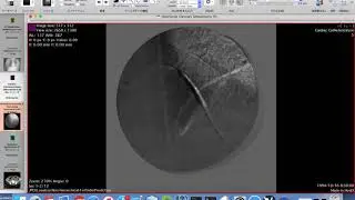 Digital Subtraction Angiography from DICOM-XA file