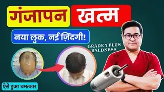 Grade 7+ Baldness Treatment by Dr. Vikram | Best Hair Transplant Solution  #NeograftChandigarh