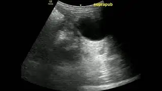 FAST with Posterior acoustic enhancement from bladder with subtle pelvic free fluid