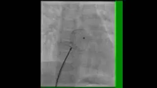 LUPV DEPLOYMENT TECHNIQUE OF ASD DEVICE l Dr. Alluri Ashok Raju l Cardiologist l Visakhapatnam