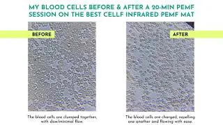 My Blood Cells Before and After a 20-minute PEMF therapy session on the BEST CELLF Infrared PEMF Mat