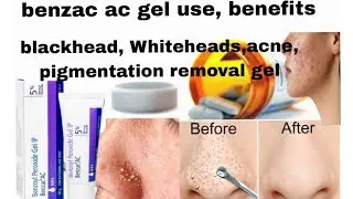 Benzac ac gel use , benefits, price//how to use benzac ac gel #benzacac
