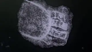 500 year old prosthesis discovered in Germany