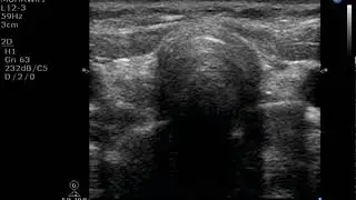 Posterior Shadowing in Ultrasound