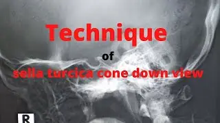 Cone down view of sella turcica (ep-40) |X-ray sella turcica | Skull cone down view |Tutorial