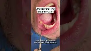 Zahnbr&uuml;cke-Wie sieht&rsquo;s im Mund aus? #zahnersatz #sch&ouml;nez&auml;hne #br&uuml;cke #zahnl&uuml;cke #zahnarzt