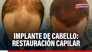 🔴🔵 Implante de cabello: Restauraci&oacute;n capilar