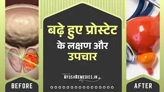 Ayurvedic treatment for enlarged prostate, prevention of BPH | prostate gland and urinary problems