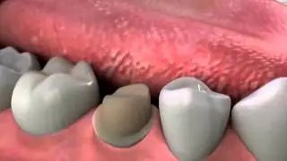 Crowns: Failing Filling
