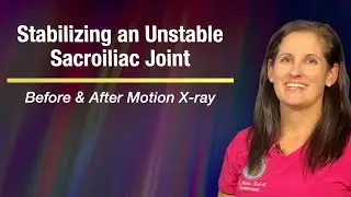 Stabilizing an unstable sacroiliac joint with Comprehensive Prolotherapy