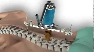 Mazor Robotics Renaissance&trade; Spine Surgery At St. Mary's