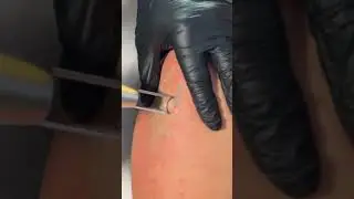 Tattoo Regret No More: Safe, Quick, and Painless Removal in San Antonio | Laser Tattoo Removal