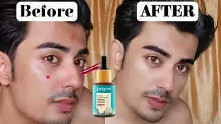 Pilgrim Peeling Solution Review | 25% AHA + 2% BHA + 5% PHA | Glass Skin at Home | Honest Results 