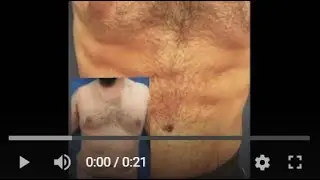 ULTRA HIGH DEFINITION ABDOMINAL ETCHING