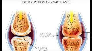 Dr. Steve Blake's Natural Approach to Osteoarthritis, Part 1 of 2
