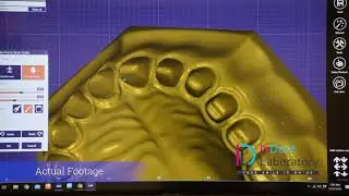 STEP 2: Model Editor on Exocad | CAD CAM Dentistry | Indent Dental Laboratory, Mumbai