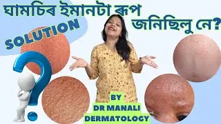 Simple ঘামচি cure &mdash; doctor tested, home trusted ✅ PRICKLY HEAT | SWEAT RASH #dermatologistassam 