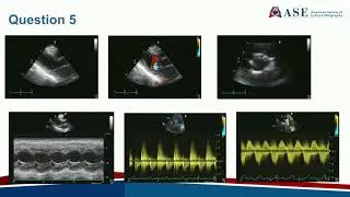 Practice Echo Board Exam on Stress Echocardiography, 3D, Hypertrophic Cardiomyopathy, and Systemic D