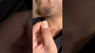 #asmrtriggers #relax #ingrownhairremoval #beard #satisfying #removal #dandruff #asmr #hair #shorts