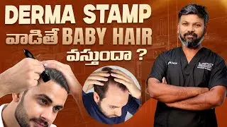 #AskDrJohnWatts | DERMA STAMP వాడితే BABY HAIR వస్తుందా ? | Hair Specialist Explains