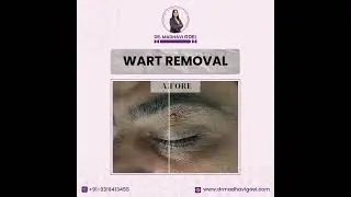 Before and After of Wart Removal