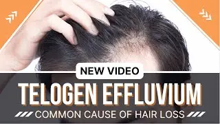 Telogen Effluvium: The Most Common Cause of Hair Loss