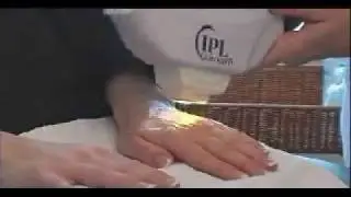 Sarasota IPL Intense Pulse Light Photorejuvenation