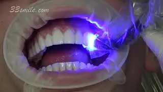 Cosmetic Prepless Dental Veneers Cosmetic Dentistry